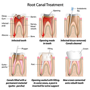 root_canal_treatment_diagram_1_boogren